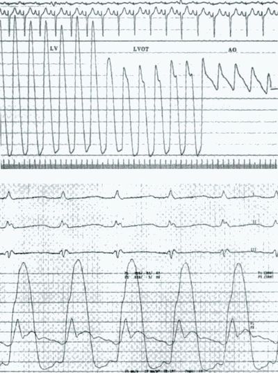 Кривые давления в камерах сердца при гипертрофической кардиомиопатии