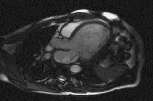 Магнитно-резонансная томография пациента с дилатационной кардиомиопатией