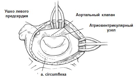 Локализация внутрисердечных структур вокруг кольца митрального клапана