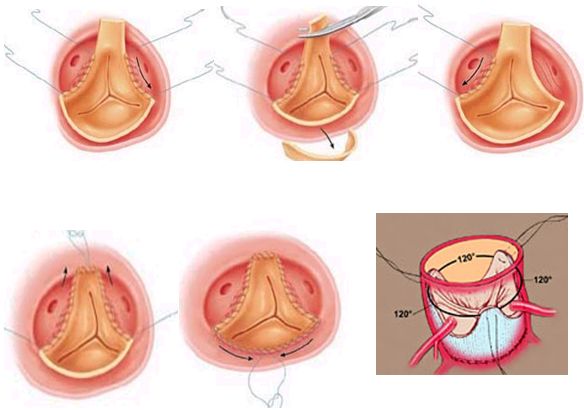 Формирование второго ряда шва при протезировании аортального клапана бескаркасным биопротезом