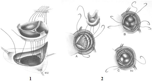 Техника наложения первого ряда швов при имплантации