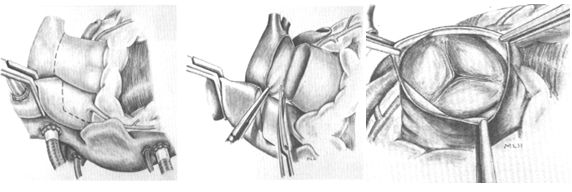 Рассечение легочной артерии и оценка клапана легочной артерии