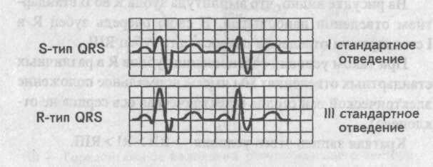 Визуальное определение электрической оси сердца. Правограмма