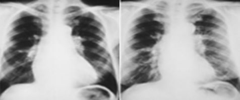 Рентгенограммы до- и после легочной тромбэндартерэктомии