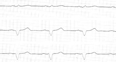 ЭКГ при бифокальной (двухкамерной) кардиостимуляции в режиме DDD