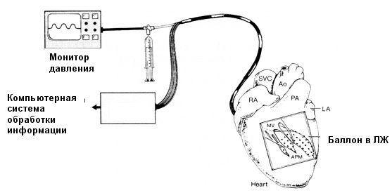 Эндокардиальное картирование левого желудочка