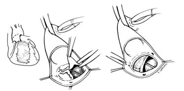 Удаление клапанов при распространении инфекции на область митрально-аортального контакта