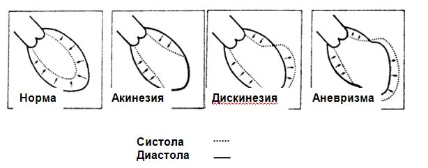 .Схематическое изображение формирования аневризмы левого желудочка