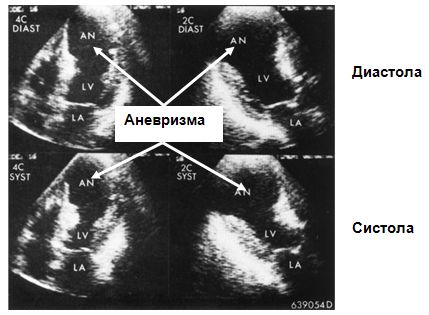 Эхокардиографическое изображение аневризмы левого желудочка