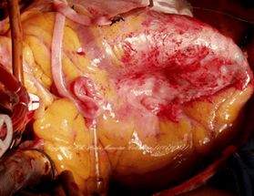 Интраопереционная фотография дискинетической аневризмы левого желудочка