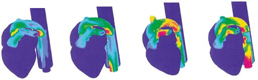 Компьютерная модель распределения стрессовых напряжений в момент травмы грудной клетки