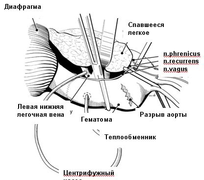Схема левопредсердно-аортального обхода