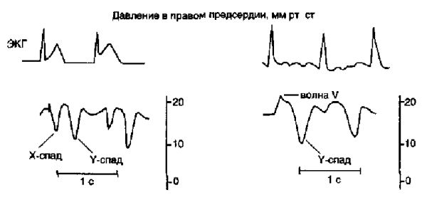 Кривые давления при инфаркте правого желудочка с трикуспидальной недостаточностью (справа) и без нее (слева)