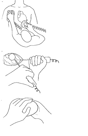 Сверху вниз:1.Правильное расположение «ложек» для наружной дефибрилляции. 2. Правильное расположение «ложек» для внутренней дефибрилляции. 3. Правильное положение рук при прямом массаже сердца.
