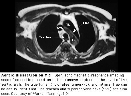 Расслоение аорты: МРТ