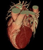Компьютерная томография сердца
