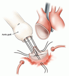 Технические особенности операции на аорте