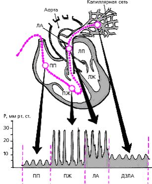 Кривая давления при катетеризации лёгочной артерии 