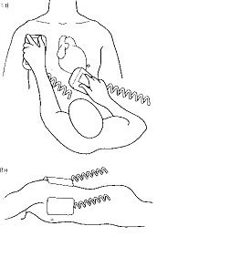 Использование дефибриллятора. Сверху: расположение «ложек» для дефибрилляции и кардиоверсии; снизу: альтернативное расположение «ложек» при синхронизированной кардиоверсии.