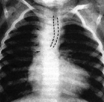 Тетрада Фалло, рентгенограмма грудной клетки