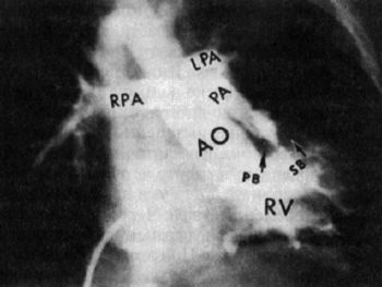 Тетрада Фалло, рентгеноконтрастное исследование сердца