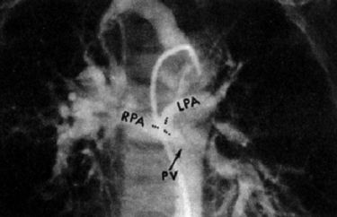 Аортография при тетраде Фалло с атрезией клапана легочной артерии