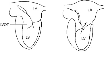 Продольный срез через митральный и аортальный клапаны и левый желудочек. Показано аномальное систолическое . Продольный срез через митральный и аортальный клапаны и левый желудочек. Показано аномальное систолическое переднее движение митрального клапана.
