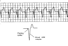 Желудочковая стимуляция: сверху вниз: общий вид ЭКГ; «спайк» стимулятора и широкий комплекс QRS