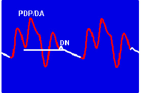 Кривая АД при работе ВАБК. PDP/DA – пиковое диастолическое давление как результат «диастолического усиления», DN – дикротический зубец 