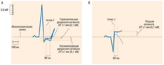 Изменения сегмента ST при ишемии миокарда